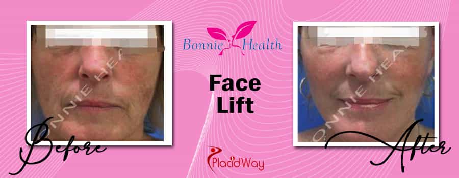 Before & After Face Lift